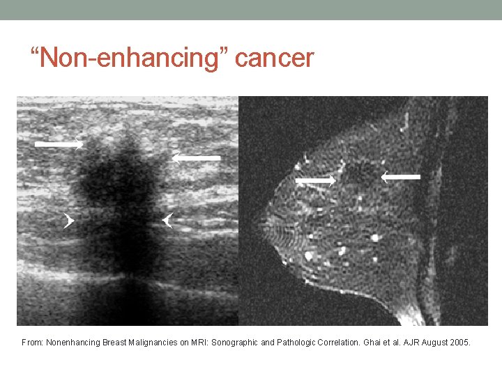 “Non-enhancing” cancer From: Nonenhancing Breast Malignancies on MRI: Sonographic and Pathologic Correlation. Ghai et