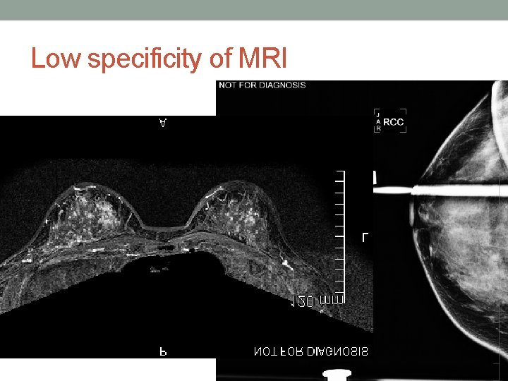Low specificity of MRI 