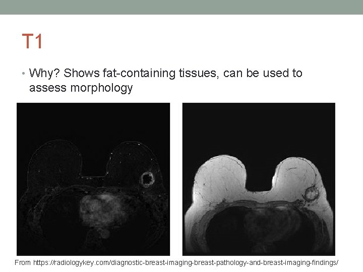 T 1 • Why? Shows fat-containing tissues, can be used to assess morphology From