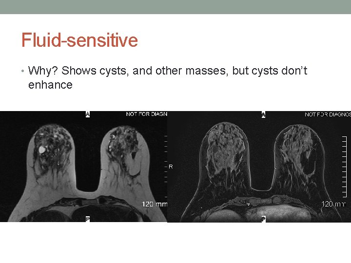 Fluid-sensitive • Why? Shows cysts, and other masses, but cysts don’t enhance 