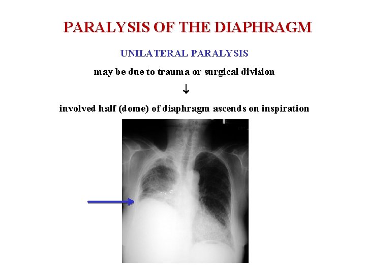PARALYSIS OF THE DIAPHRAGM UNILATERAL PARALYSIS may be due to trauma or surgical division