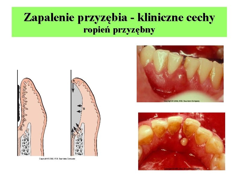 Zapalenie przyzębia - kliniczne cechy ropień przyzębny 