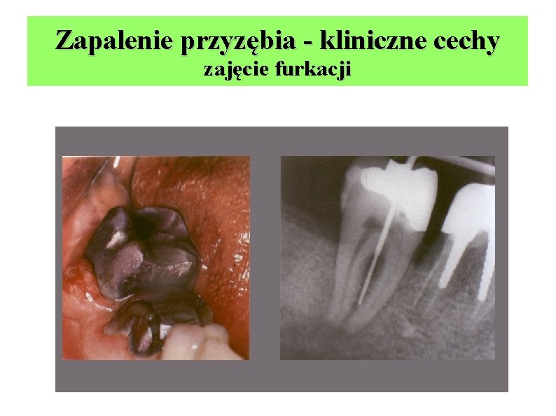 Zapalenie przyzębia - kliniczne cechy zajęcie furkacji 