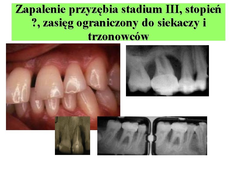 Zapalenie przyzębia stadium III, stopień ? , zasięg ograniczony do siekaczy i trzonowców 