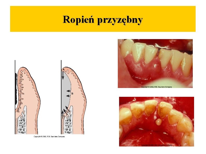 Ropień przyzębny 