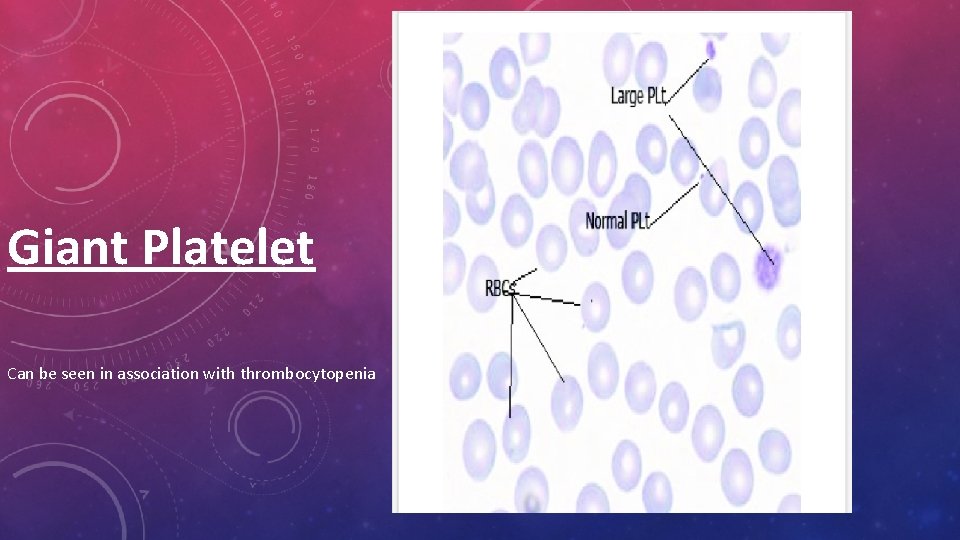Giant Platelet Can be seen in association with thrombocytopenia 