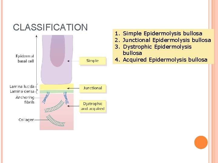 CLASSIFICATION 1. Simple Epidermolysis bullosa 2. Junctional Epidermolysis bullosa 3. Dystrophic Epidermolysis bullosa 4.