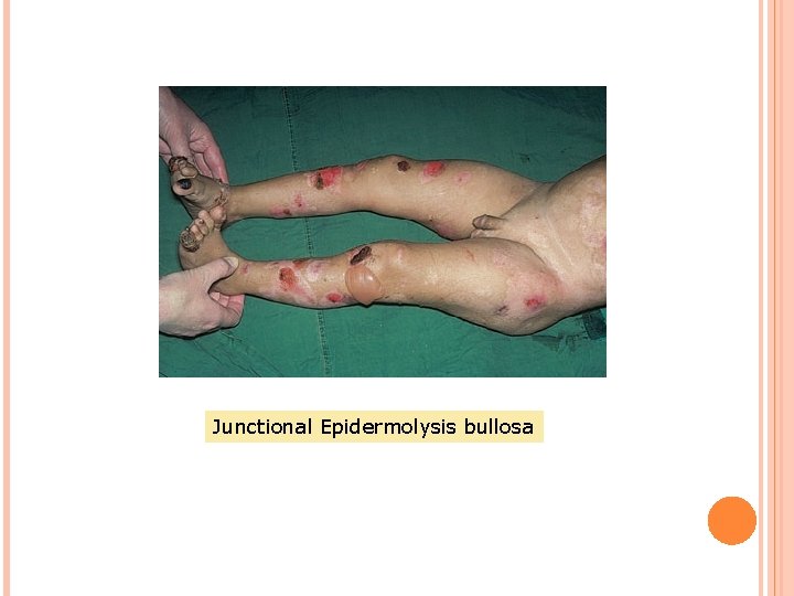 Junctional Epidermolysis bullosa 