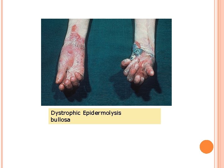 Dystrophic Epidermolysis bullosa 