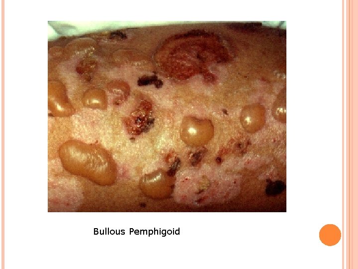 Bullous Pemphigoid 