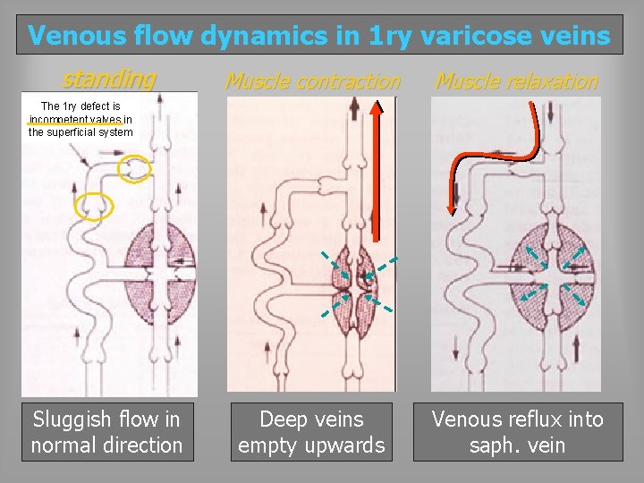 Venous flow dynamics in 1 ry varicose veins standing Muscle contraction Muscle relaxation Deep