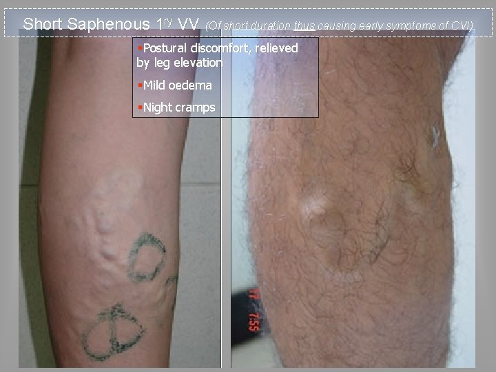 Short Saphenous 1 ry VV (Of short duration thus causing early symptoms of CVI)