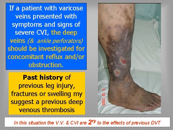 If a patient with varicose veins presented with symptoms and signs of severe CVI,