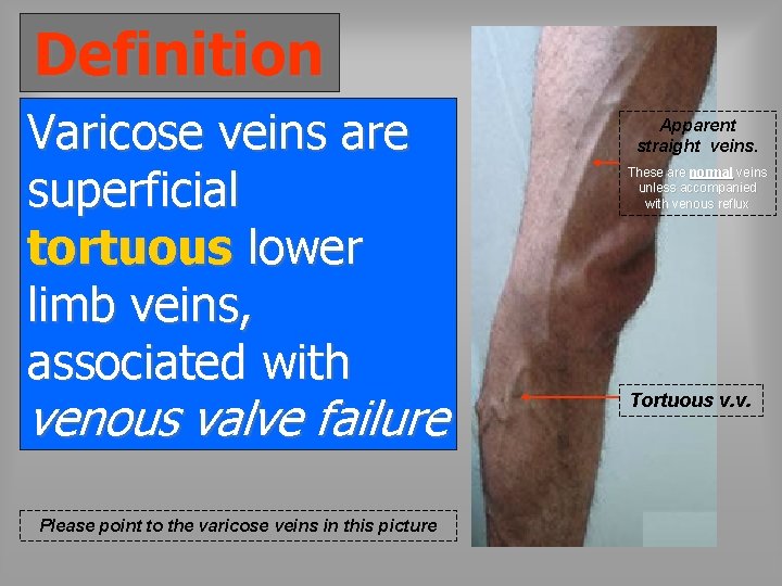 Definition Varicose veins are superficial tortuous lower limb veins, associated with venous valve failure