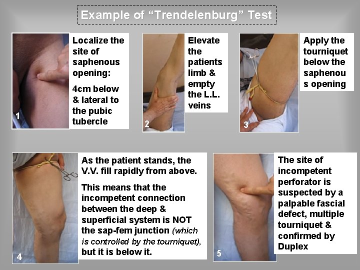 Example of “Trendelenburg” Test Localize the site of saphenous opening: 1 4 cm below