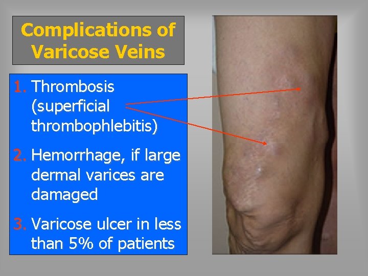 Complications of Varicose Veins 1. Thrombosis (superficial thrombophlebitis) 2. Hemorrhage, if large dermal varices