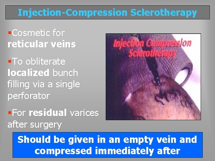 Injection-Compression Sclerotherapy §Cosmetic for reticular veins §To obliterate localized bunch filling via a single