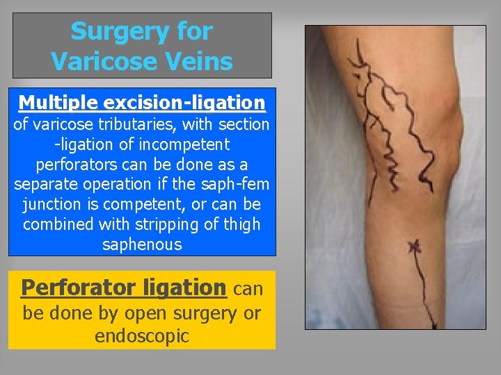 Surgery for Varicose Veins Multiple excision-ligation of varicose tributaries, with section -ligation of incompetent