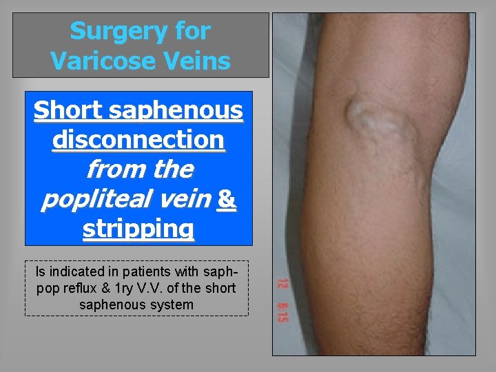 Surgery for Varicose Veins Short saphenous disconnection from the popliteal vein & stripping Is
