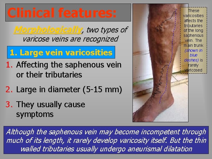 Clinical features: Morphologically, two types of varicose veins are recognized 1. Large vein varicosities