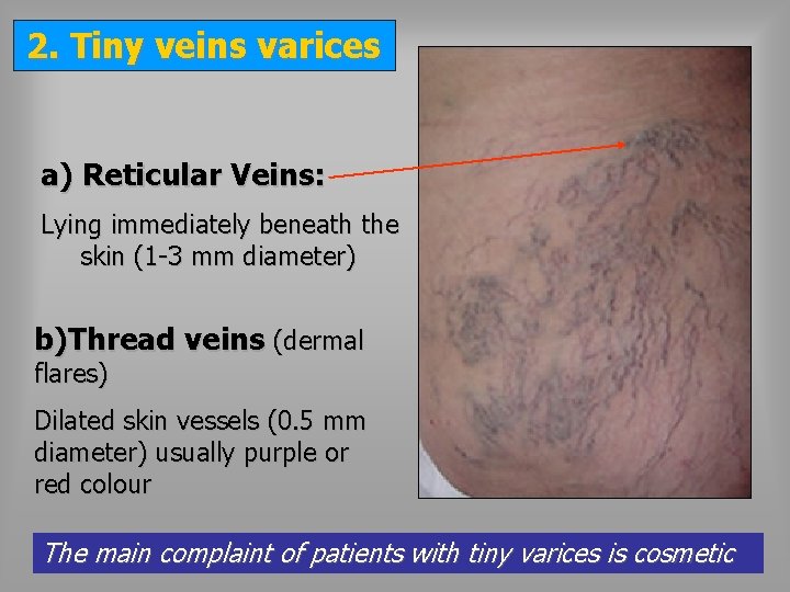 2. Tiny veins varices a) Reticular Veins: Lying immediately beneath the skin (1 -3