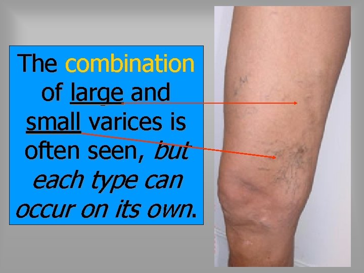 The combination of large and small varices is often seen, but each type can