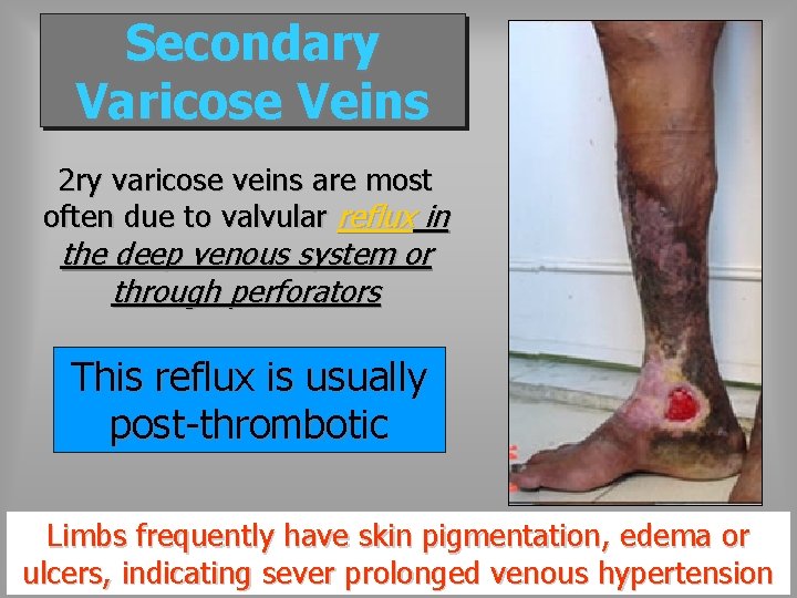 Secondary Varicose Veins 2 ry varicose veins are most often due to valvular reflux