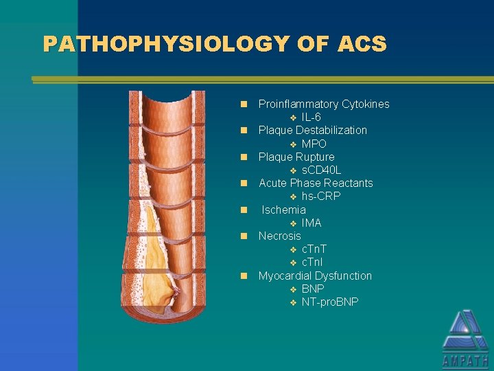 PATHOPHYSIOLOGY OF ACS n n n n Proinflammatory Cytokines v IL-6 Plaque Destabilization v