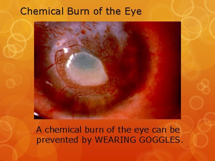 Chemical Burn of the Eye A chemical burn of the eye can be prevented