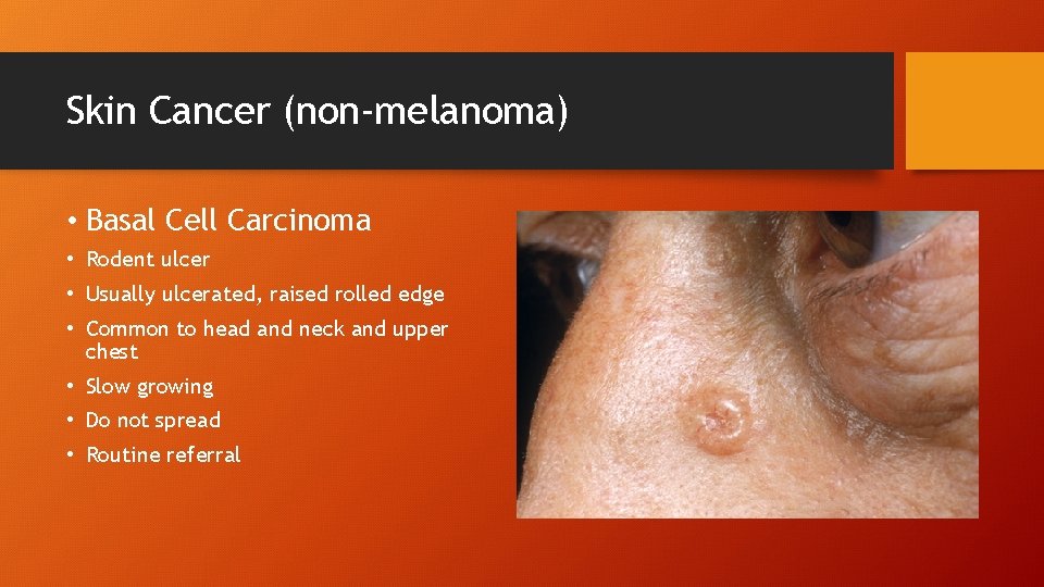 Skin Cancer (non-melanoma) • Basal Cell Carcinoma • Rodent ulcer • Usually ulcerated, raised