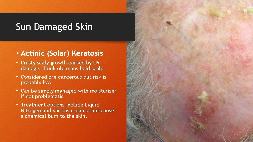 Sun Damaged Skin • Actinic (Solar) Keratosis • Crusty scaly growth caused by UV