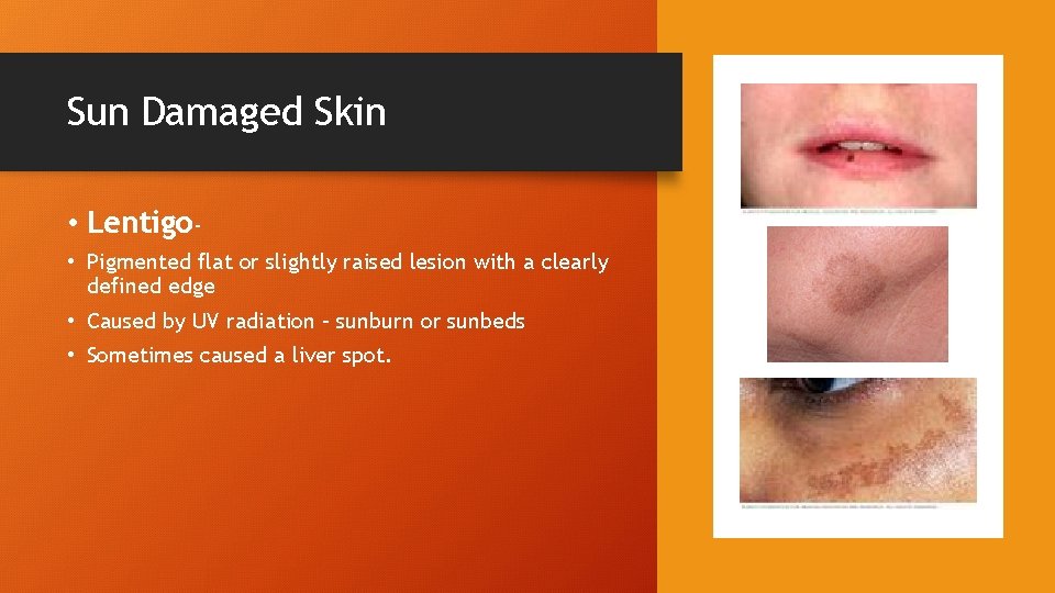 Sun Damaged Skin • Lentigo • Pigmented flat or slightly raised lesion with a
