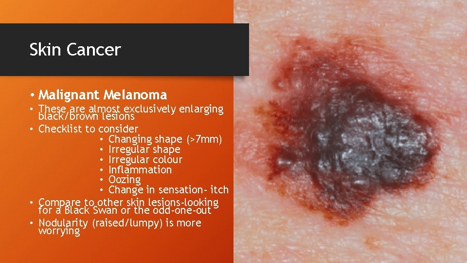 Skin Cancer • Malignant Melanoma • These are almost exclusively enlarging black/brown lesions •
