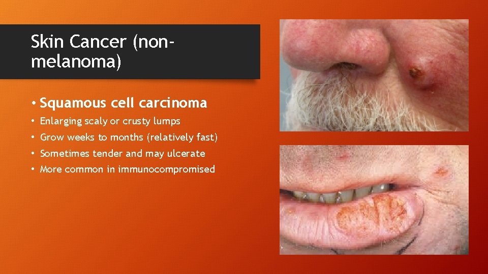 Skin Cancer (nonmelanoma) • Squamous cell carcinoma • Enlarging scaly or crusty lumps •