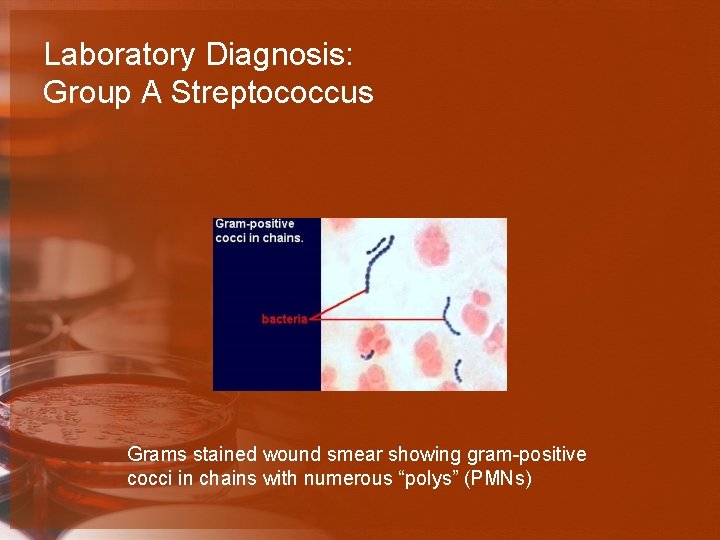 Laboratory Diagnosis: Group A Streptococcus Grams stained wound smear showing gram-positive cocci in chains