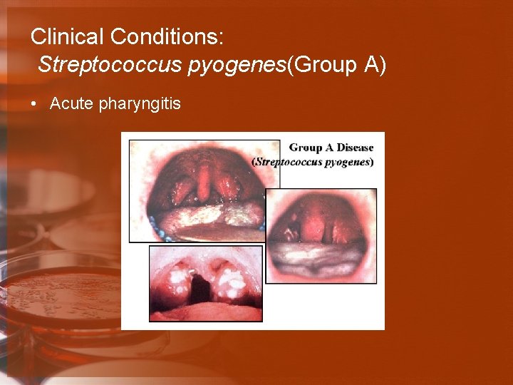 Clinical Conditions: Streptococcus pyogenes(Group A) • Acute pharyngitis 