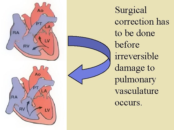 Surgical correction has to be done before irreversible damage to pulmonary vasculature occurs. 