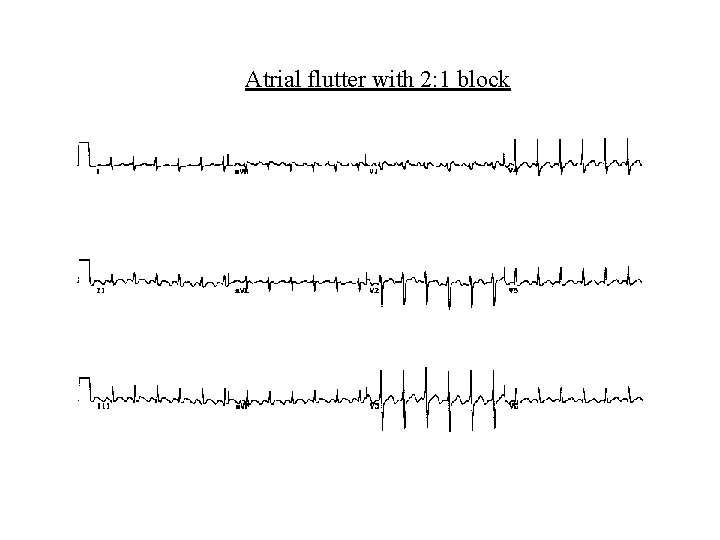 Atrial flutter with 2: 1 block 