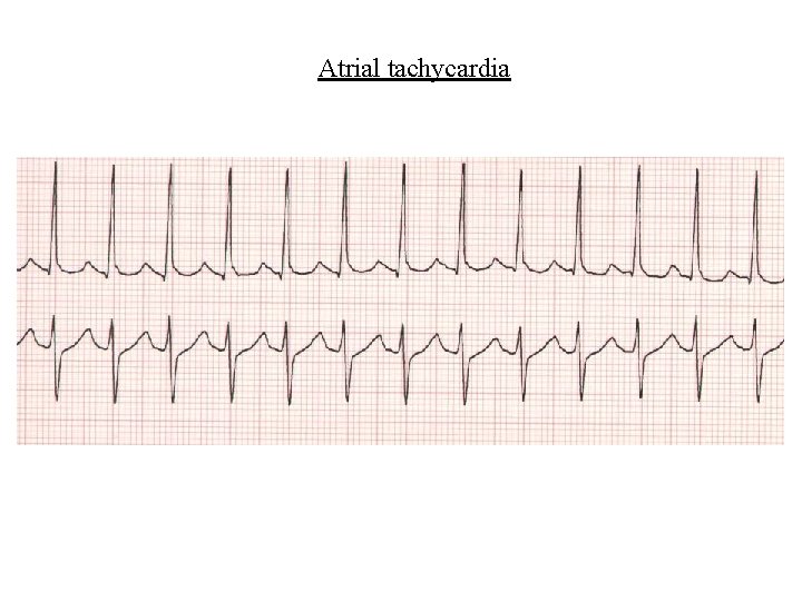 Atrial tachycardia 