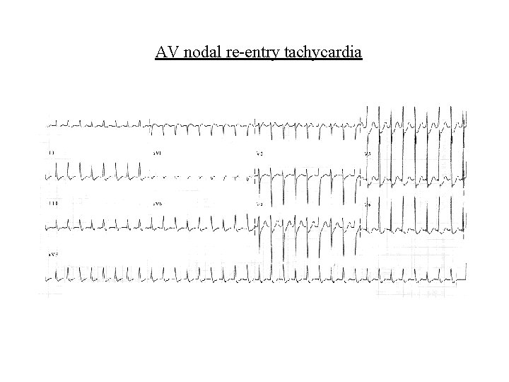 AV nodal re-entry tachycardia 