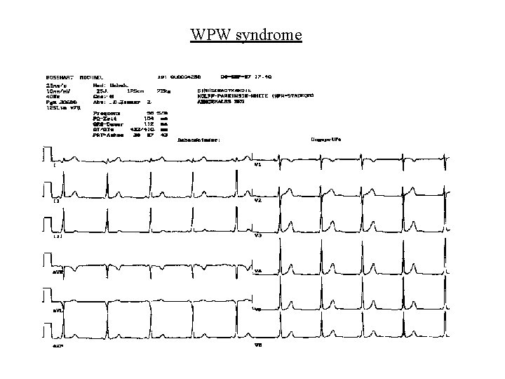 WPW syndrome 