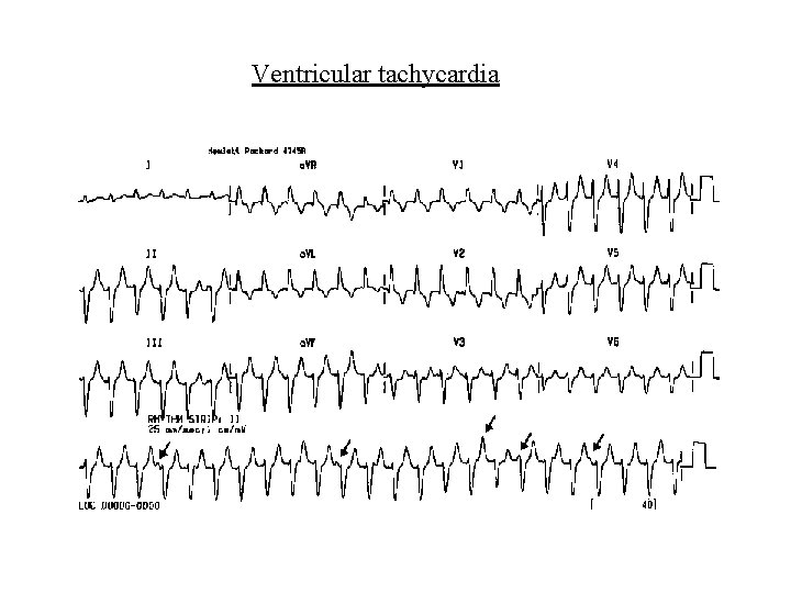 Ventricular tachycardia 