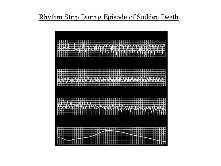 Rhythm Strip During Episode of Sudden Death 