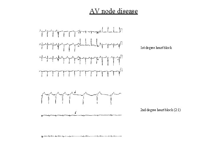 AV node disease 1 st degree heart block 2 nd degree heart block (2: