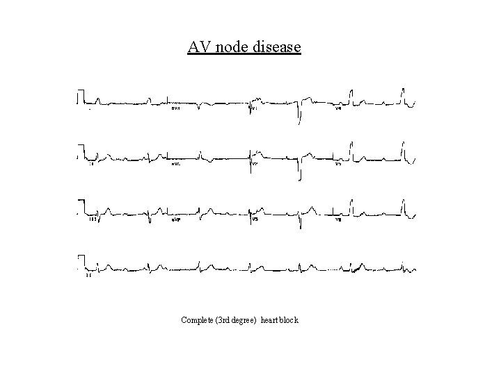 AV node disease Complete (3 rd degree) heart block 