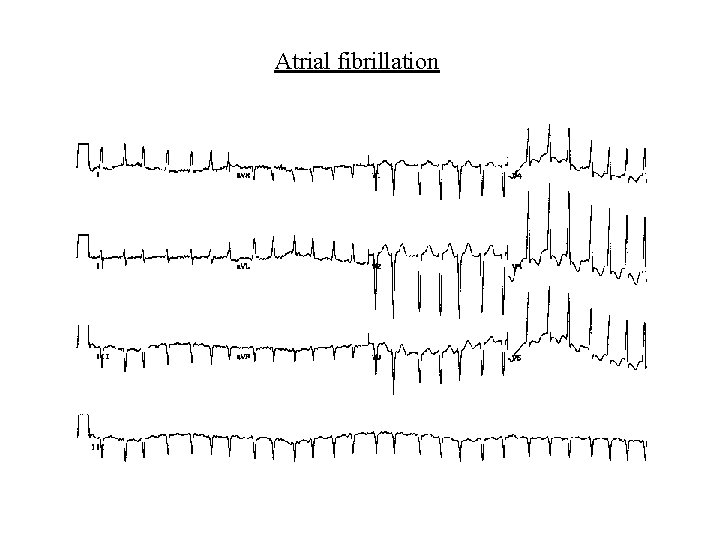 Atrial fibrillation 