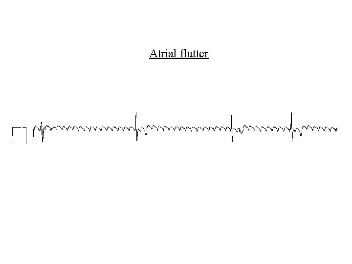 Atrial flutter 