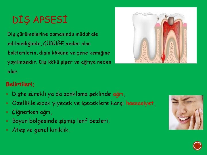 DİŞ APSESİ Diş çürümelerine zamanında müdahale edilmediğinde, ÇÜRÜĞE neden olan bakterilerin, dişin köküne ve