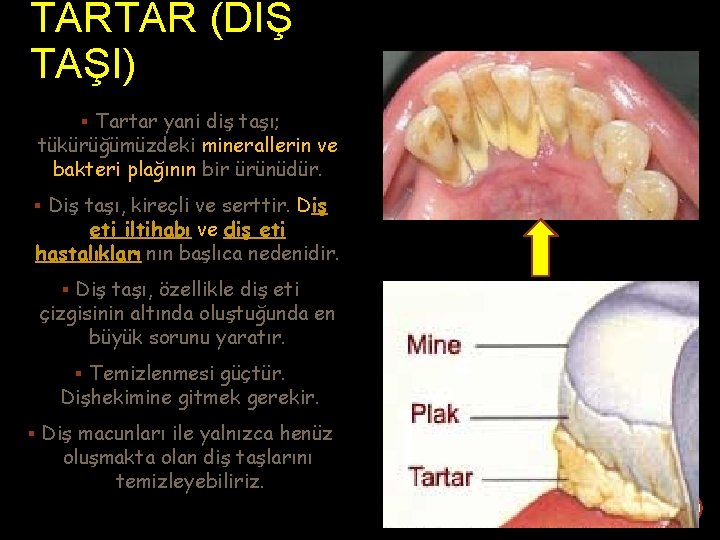 TARTAR (DİŞ TAŞI) Tartar yani diş taşı; tükürüğümüzdeki minerallerin ve bakteri plağının bir ürünüdür.