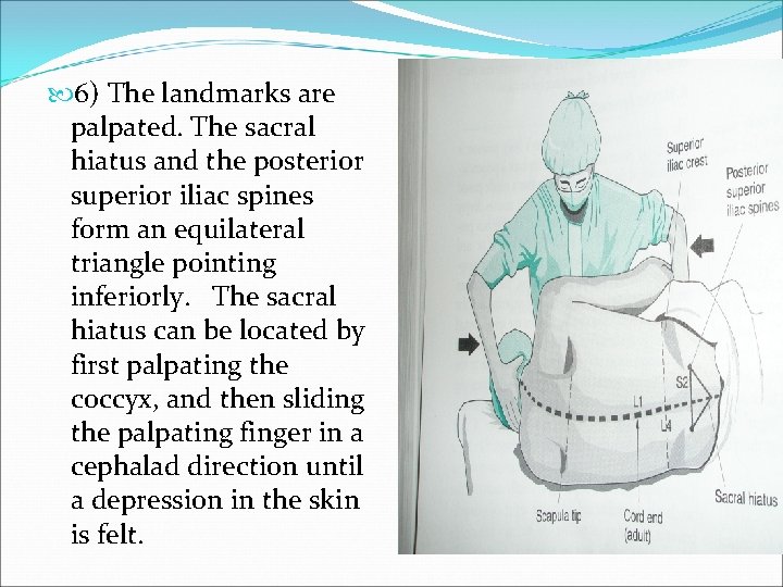  6) The landmarks are palpated. The sacral hiatus and the posterior superior iliac
